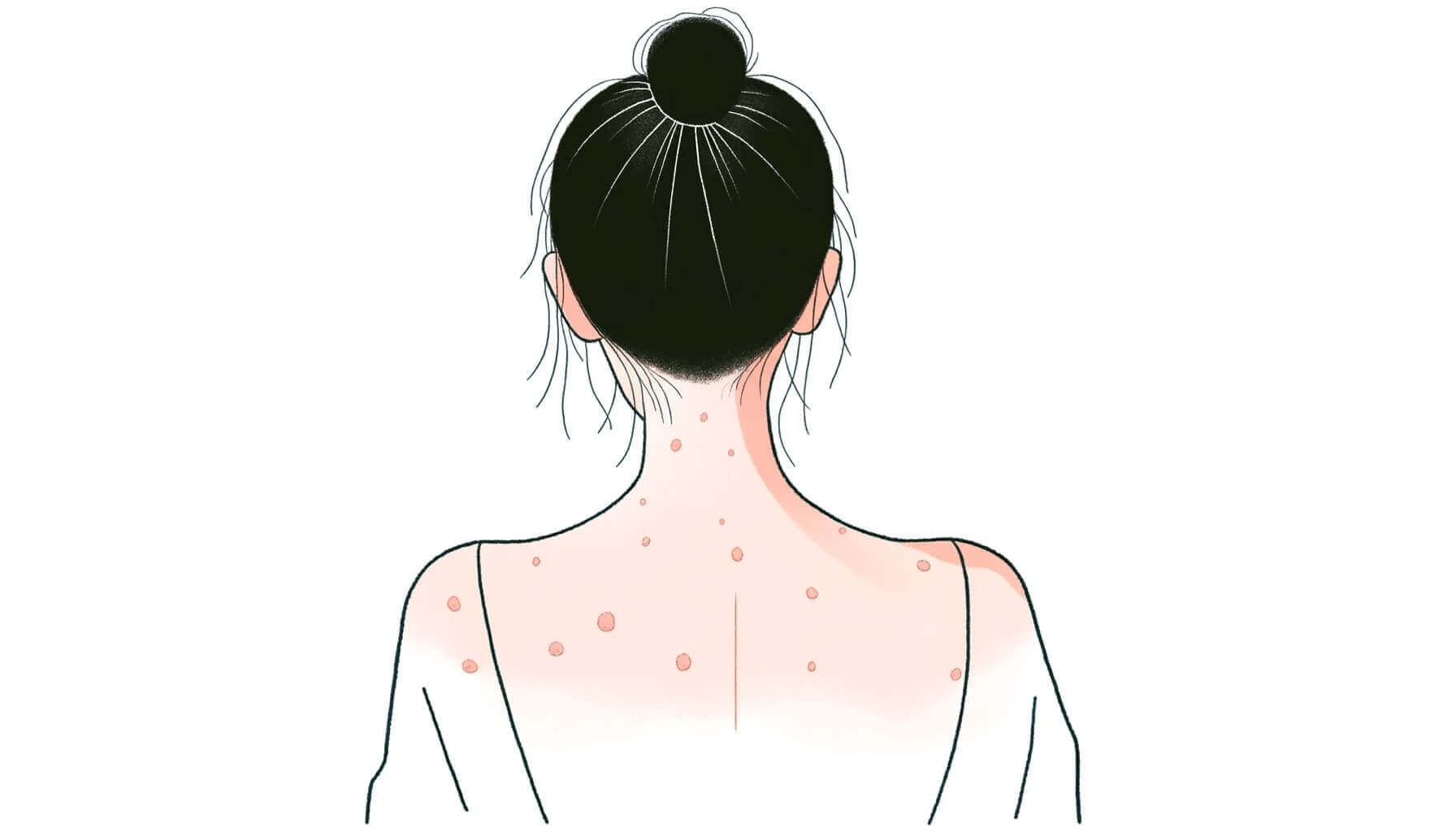 Easy Tips for Preventing and Getting Rid of Shoulder Acne: Simple Skincare Strategies