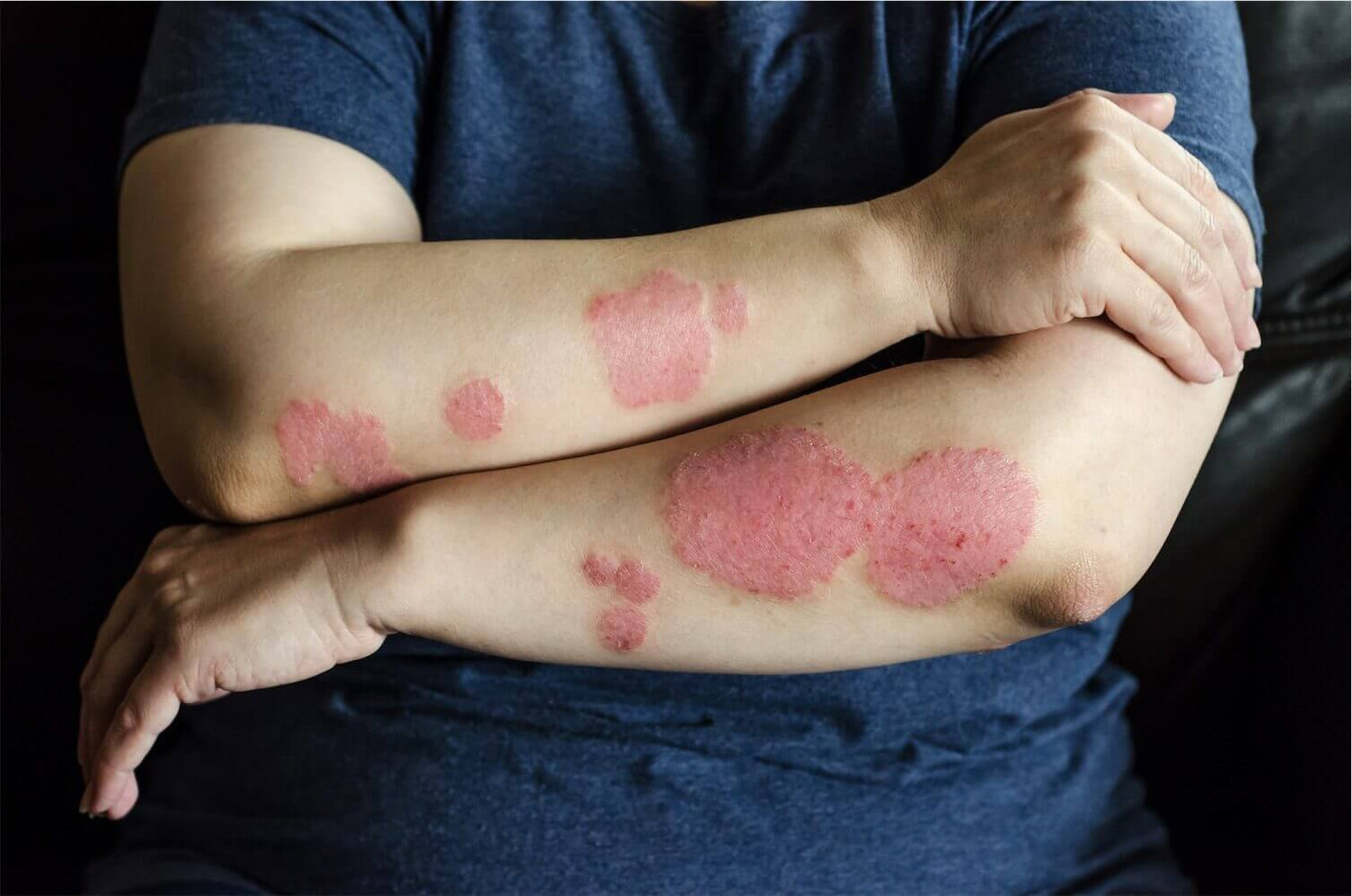 Treatment of Psoriasis