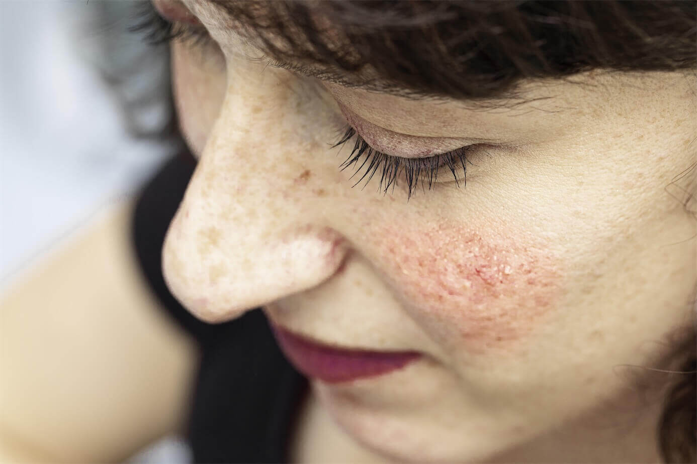 Rosacea treatment