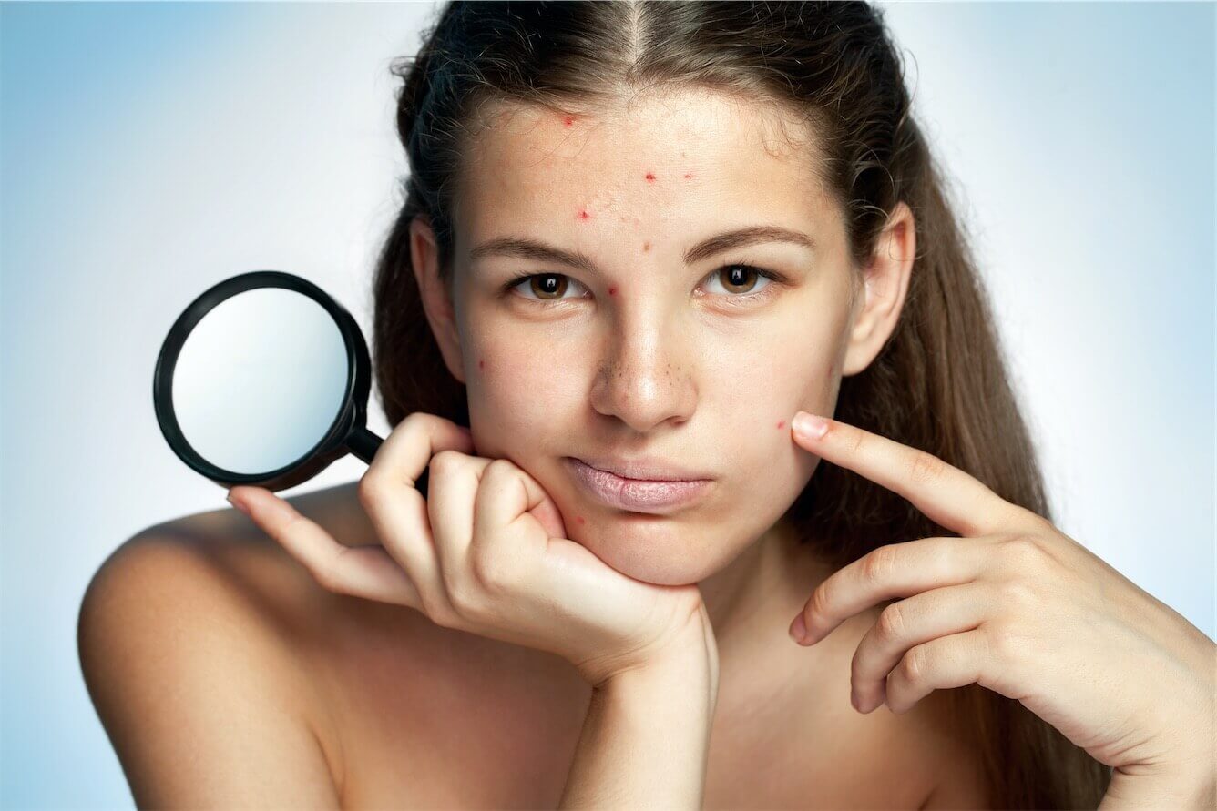 Teen acne and skin problems