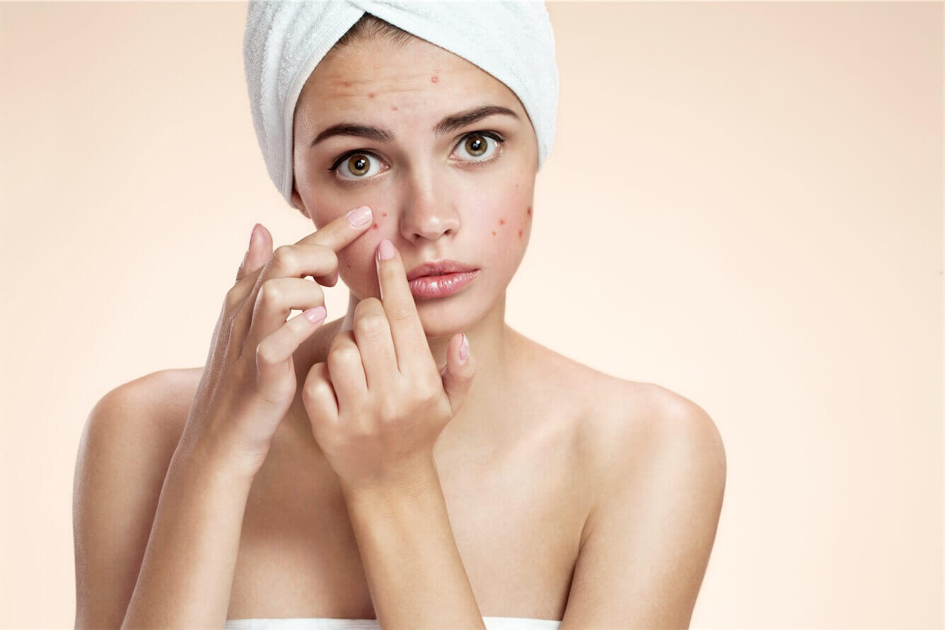 What is the difference between acne and pimples?